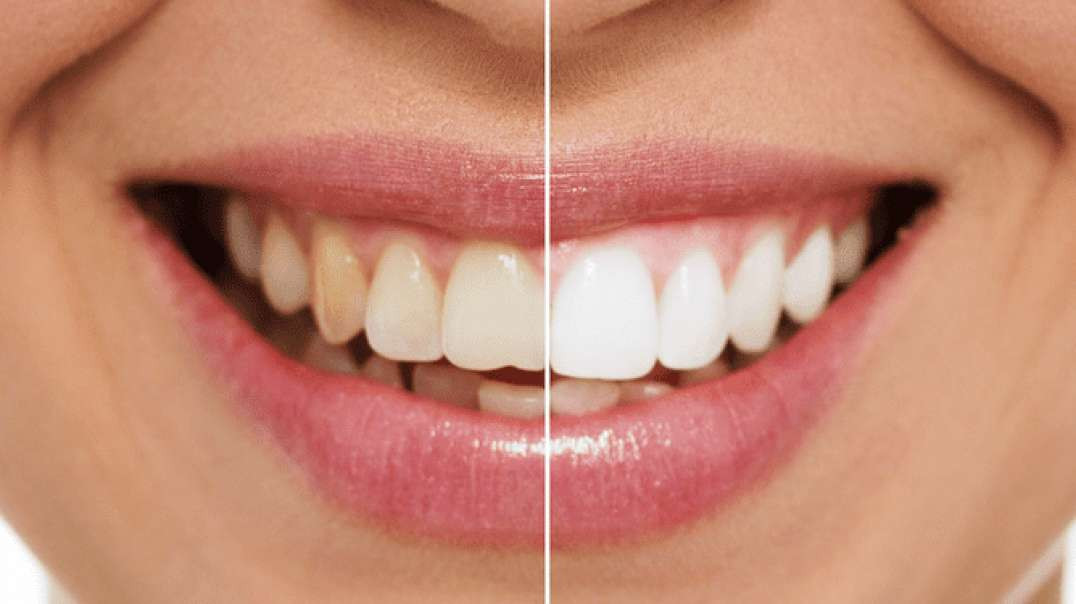 Teeth Whitening