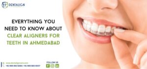 Everything You Need to Know About Clear Aligners for Teeth in Ahmedabad