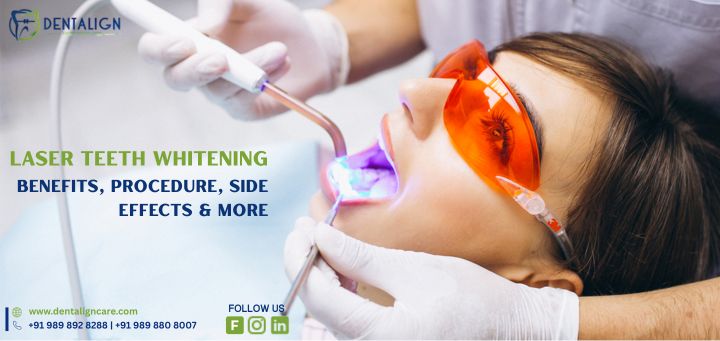 Laser Teeth Whitening: Benefits, Procedure, Side Effects & More
