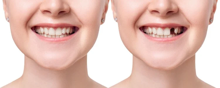 Dental Implant