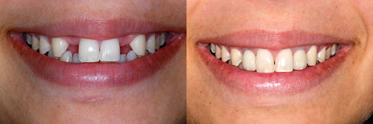 Dental Implants