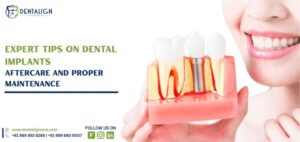 Expert Tips on Dental Implants Aftercare and Proper Maintenance