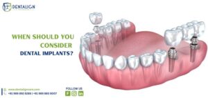 When Should You Consider Dental Implants