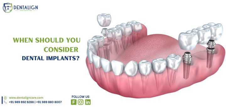When Should You Consider Dental Implants