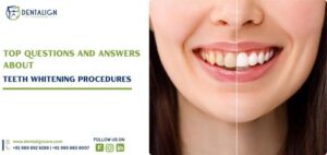 Top Questions Answered About Teeth Whitening Procedures
