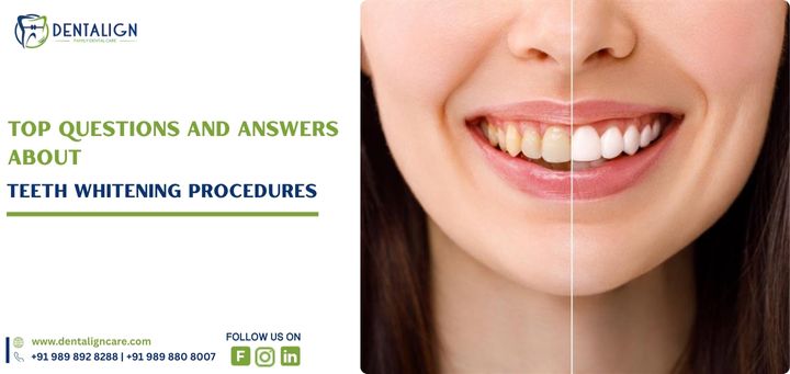 Top Questions Answered About Teeth Whitening Procedures
