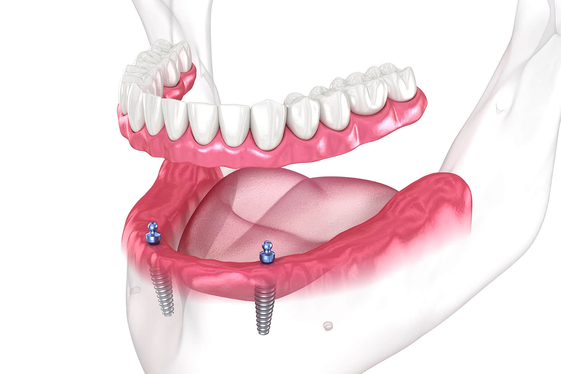 Dental Prosthesis